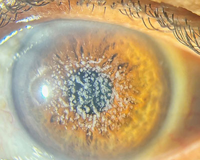 Cornea & External Eye Disease