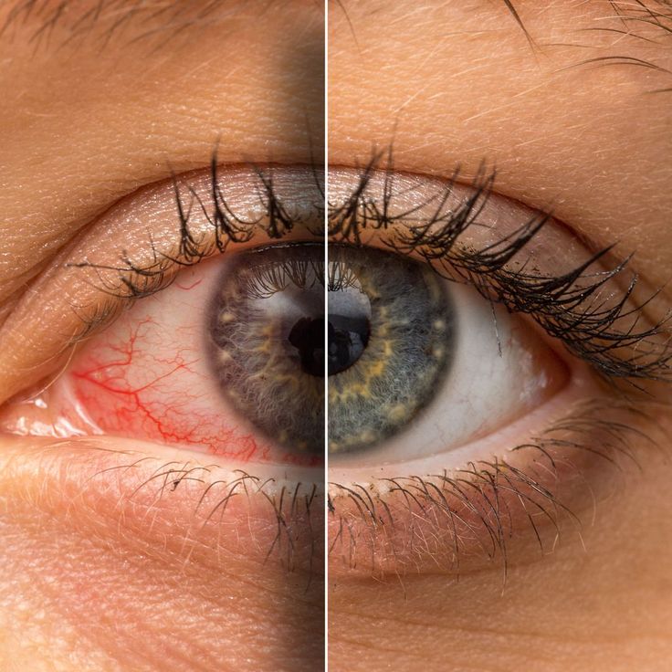 Dry Eye Disease