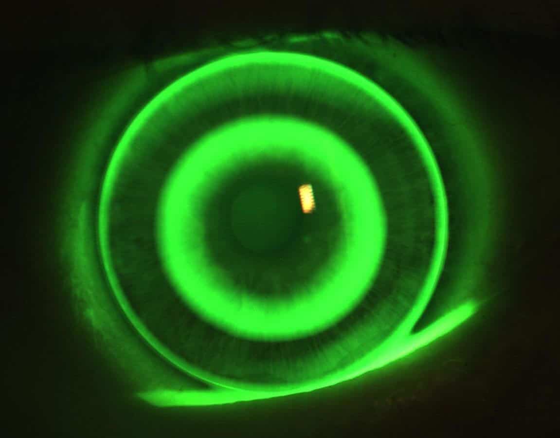 Scleral Contact Lens